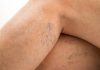Varicose Veins during Pregnancy