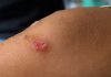 Impetigo in Children