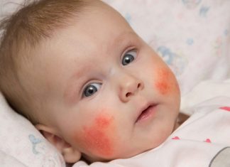 Eczema in Babies – Reasons, Symptoms & Treatment