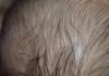 Alopecia Areata in Kids