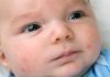 Baby Acne – Causes, Symptoms & Treatment Baby acne – Causes, symptoms & treatment