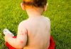 Hives(Urticaria) In Children Hives in Children