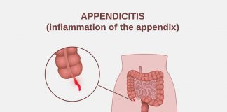 Appendicitis in Pregnancy APPENDICITIS