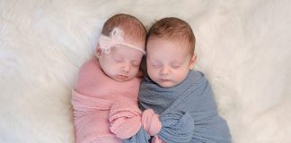 Conjoined Twins (Siamese Twins) Conjoined Twins (Siamese Twins)