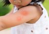 Dengue in Children – Signs, Diagnosis & Treatment Dengue in Children - Signs, Diagnosis & Treatment
