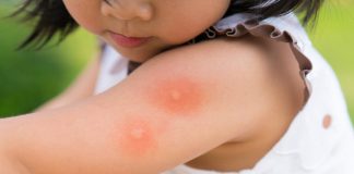 Dengue in Children – Signs, Diagnosis & Treatment Dengue in Children - Signs, Diagnosis & Treatment