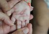 Psoriasis in Children PSORIASIS