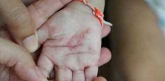 Psoriasis in Children PSORIASIS