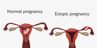 Heterotopic Pregnancy HETEROTOPIC PREGNANCY