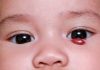 Infantile Hemangioma – Causes, Complications and Treatment