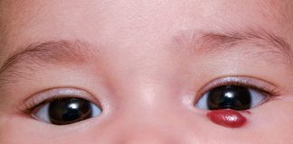 Infantile Hemangioma – Causes, Complications and Treatment