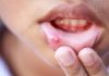 11 Home Remedies for Mouth Ulcers in Children 10 Home Remedies for Mouth Ulcer in Babies and Children