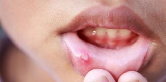 11 Home Remedies for Mouth Ulcers in Children 10 Home Remedies for Mouth Ulcer in Babies and Children