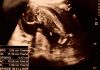 15 Weeks Pregnant Ultrasound 15 Weeks Pregnant Ultrasound