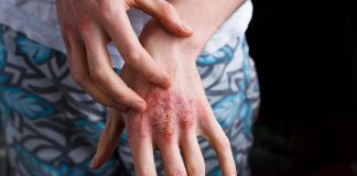 Psoriasis in Pregnancy – Symptoms, Risks and Treatment PSORIASIS