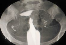 Chances of Getting Pregnant After an HSG (Hysterosalpingogram) Test An HSG test