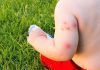 Bed Bug Bites on Babies and Children- Health Risks and Treatment Bed Bug Bites on Babies and Children- Health Risks and Treatment