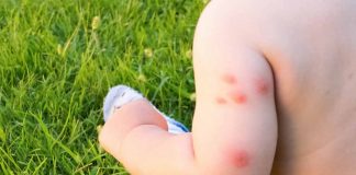 Bed Bug Bites on Babies and Children- Health Risks and Treatment Bed Bug Bites on Babies and Children- Health Risks and Treatment