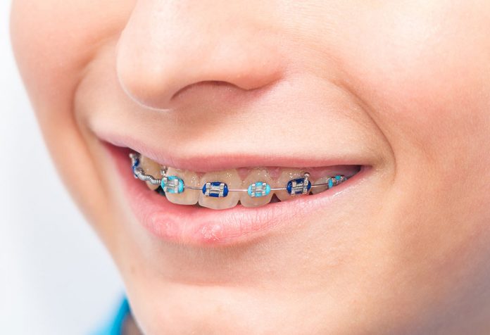 Braces for Kids Teeth