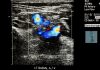 Doppler Scan in Pregnancy Doppler Scan in Pregnancy